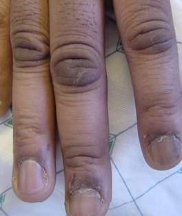 Dedos de niños con acantosis pigmentaria