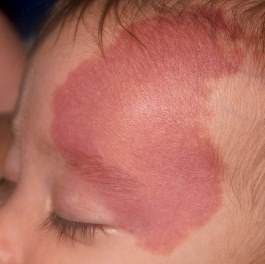 Rostro de un niño con una mancha de vino de Oporto en el costado izquierdo del rostro