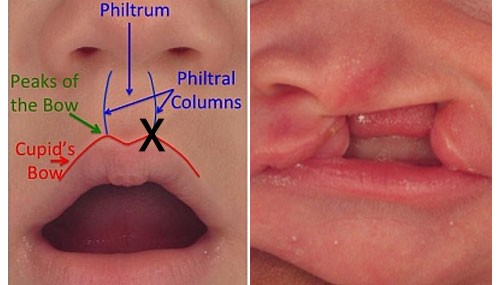 formación normal del labio en comparación con un caso de labio leporino unilateral