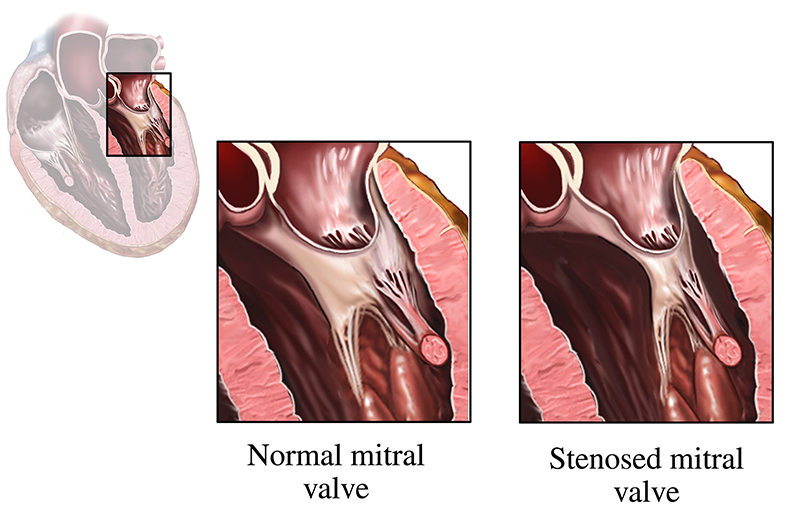 estenosis mitral que muestra una válvula mitral normal y una válvula mitral estenosada en el corazón