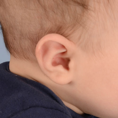 Bebé con orejas de Stahl antes del tratamiento de moldeado de orejas