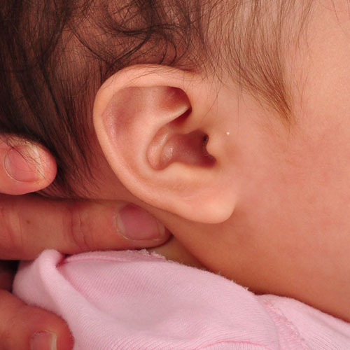 oreja de un bebé después del tratamiento de reconstrucción y moldeado de orejas