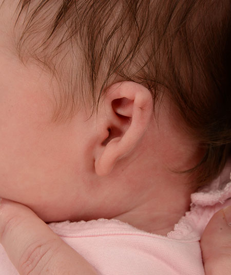 un bebé con orejas constreñidas antes del tratamiento de moldeado de orejas