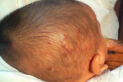 Cuero cabelludo de un bebé que tiene foliculitis