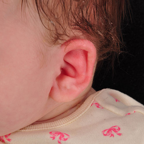Oreja de un bebé después del tratamiento de moldeado por orejas constreñidas