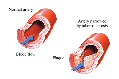 Pediatric atherosclerosis - Children's Health Heart Center