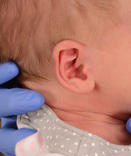 oreja de un bebé antes del modelado