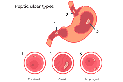 Peptic Ulcer - Children's Health