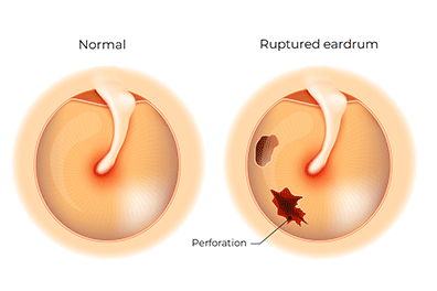 Pympanic membrane perforation (ruptured eardrum) - Children's Health