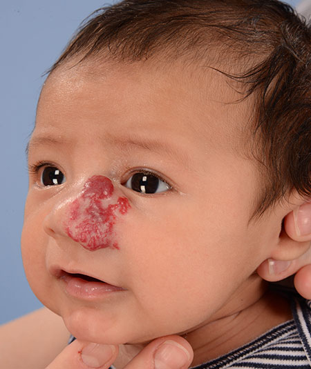 foto de un bebé con hemangioma en la nariz antes del tratamiento