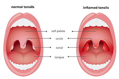 Pediatric tonsillitis - Chrildren's Health