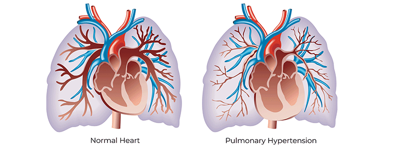 Pediatric pulmonary hypertension - Children's Health