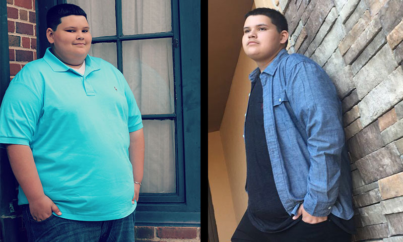 Paciente Jacob antes y después de la cirugía