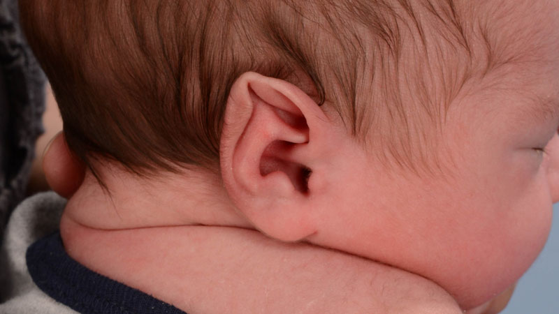 bebé con oreja de Stahl