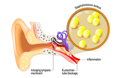 Ear Infection (Otitis Media) - Children's Health