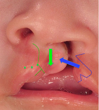 diagrama de reparación de labio leporino