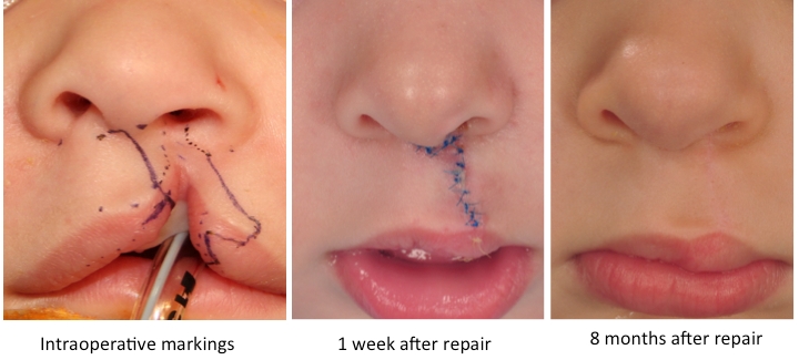 figuras de reparación de labio leporino unilateral