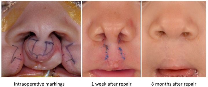 figuras de reparación de labio leporino bilateral