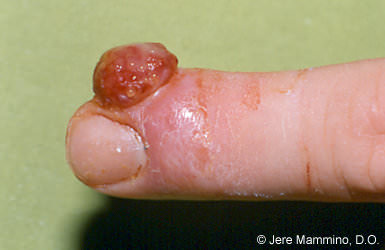 Granuloma piógeno en la punta de un dedo