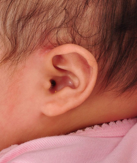 oreja de un bebé después del modelado