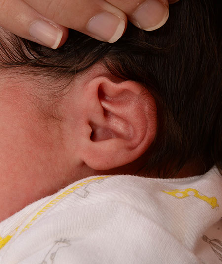 Oreja de un bebé con deformidad de borde helicoidal antes del tratamiento de moldeado