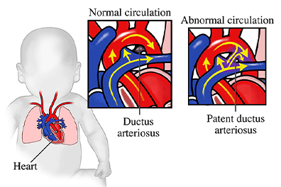 Pediatric patent ductus arteriosus (PDA) Children's Health