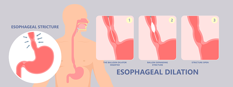 Esophageal stricture in children - Children's Health