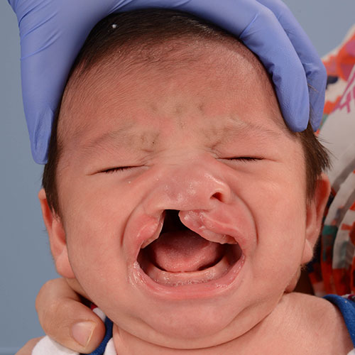 foto de un niño antes de recibir tratamiento para labio leporino