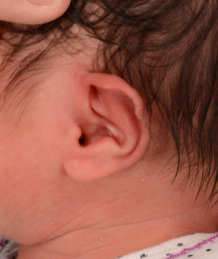 oreja de un bebé antes del modelado