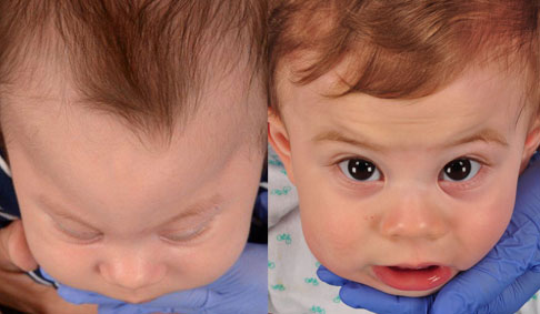 el antes y el después de un bebé con craneosinostosis metópica