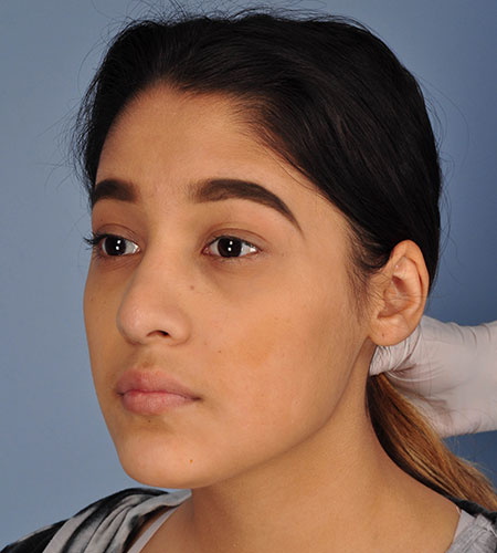 una niña después de una rinoplastia por un traumatismo nasal