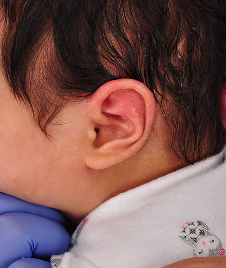 un bebé después de recibir tratamiento de moldeado por pliegue helicoidal