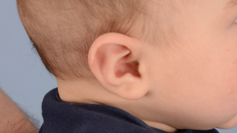 bebé con oreja de Stahl después del tratamiento de moldeado de orejas