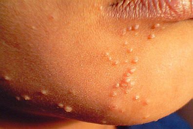 Niño que tiene pequeñas protuberancias en el rostro causadas por el virus del molusco contagioso