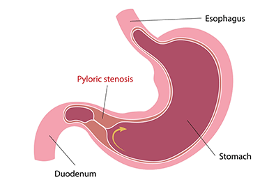 Pediatric pyloric stenosis - Children's Health