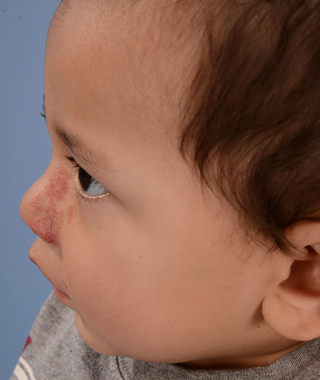 foto de un niño después de la extracción de un hemangioma