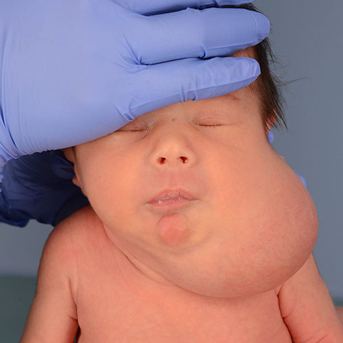 Un bebé antes de la extracción de una malformación vascular 