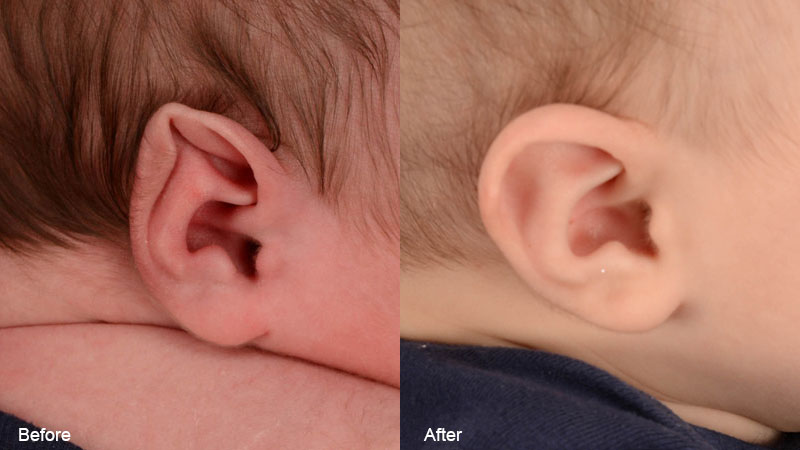Oreja de un bebé antes y después del tratamiento de moldeado por orejas de Stahl