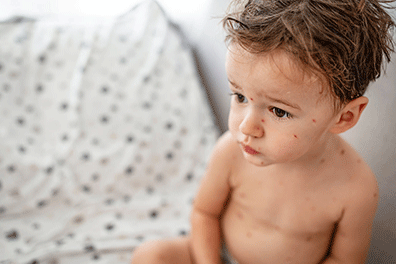 Chicken pox - Children's Health