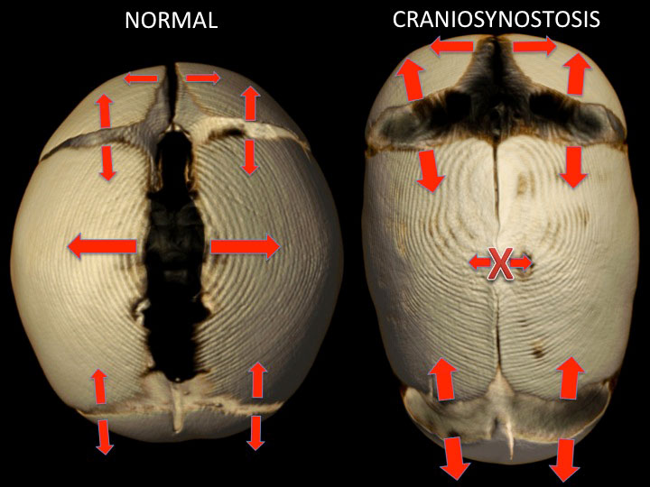 imágenes de un cráneo normal y otro con craneosinostosis