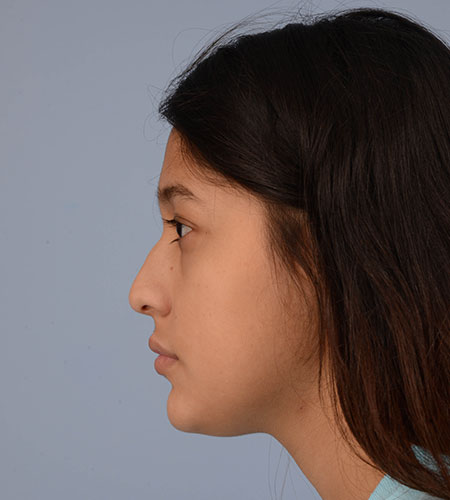 una niña antes de una rinoplastia para corregir un traumatismo nasal