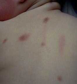 espalda de niño con urticaria pigmentosa