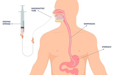 Parenteral nutrition TPN Feeding Nutrition - Children's Health