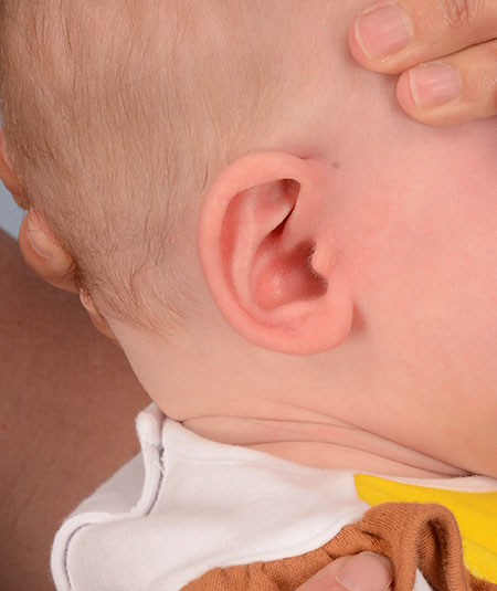 oreja de un bebé después de la reconstrucción y el moldeado de orejas