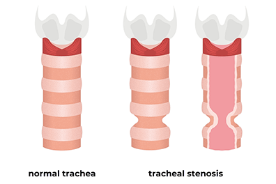 Pediatric tracheal stenosis - Children's Health