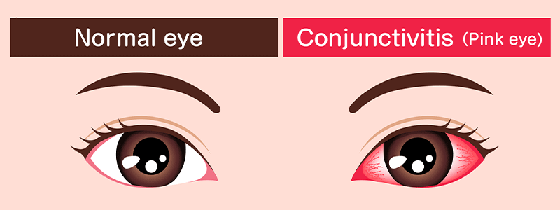 Allergic conjunctivitis (pink eye) - Children's Health