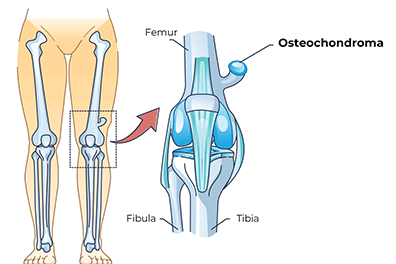 Osteochondroma - Children's Health