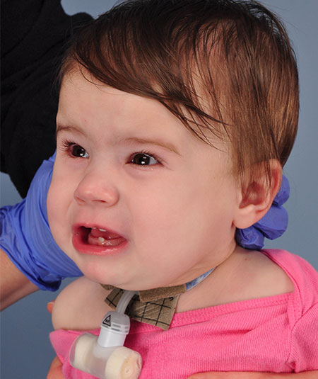 un bebé después de la extracción de una malformación vascular