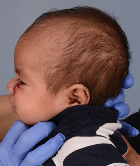 foto de un bebé con un hemangioma debajo del ojo antes del tratamiento