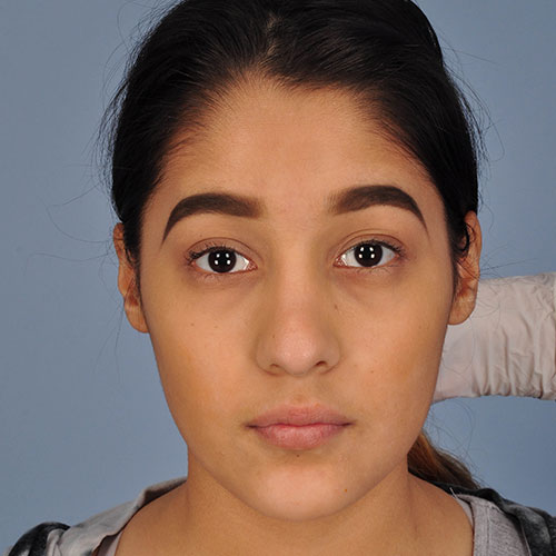 una niña después de una rinoplastia para corregir un traumatismo nasal